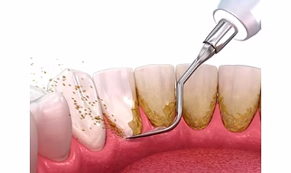 Oral Prophylaxis