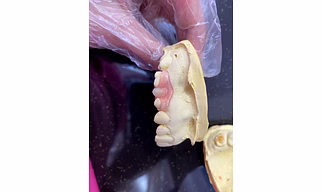 Unilateral Flexible Denture