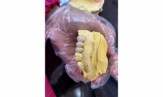 PFM tilite crowns / bridge