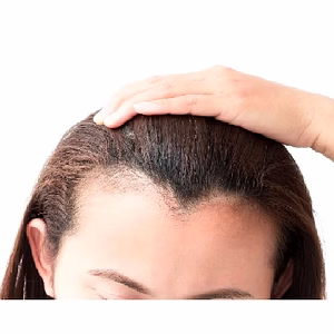 Ladies Front Line Hair System