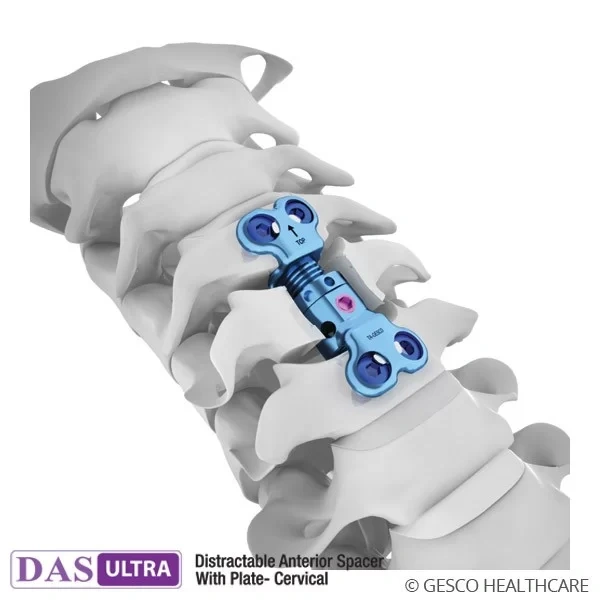 Distractable Anterior Spacer with Screw Plates Spinal Implants-1