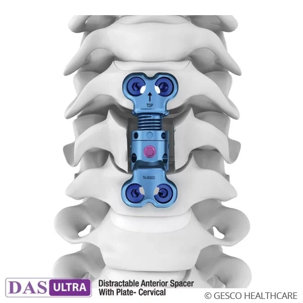 Distractable Anterior Spacer with Screw Plates Spinal Implants-2