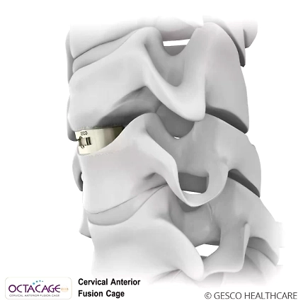 Cervical Anterior Interbody cage PEEK Spine implants-1