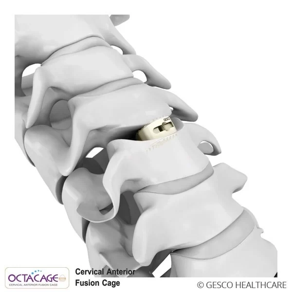 Cervical Anterior Interbody cage PEEK Spine implants-2