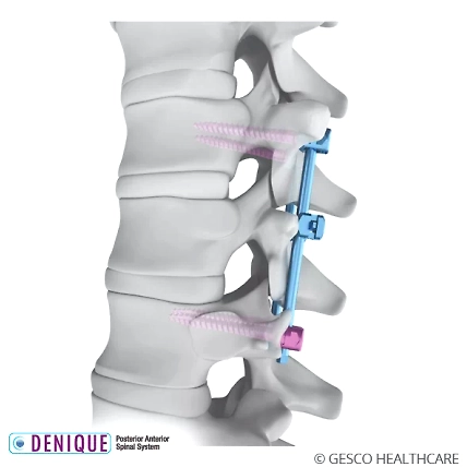 Posterior Anterior Spinal Systems-1