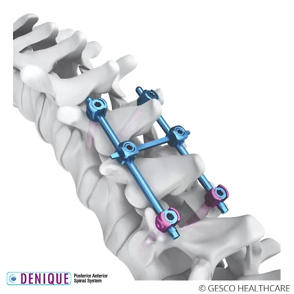Posterior Anterior Spinal Systems-2