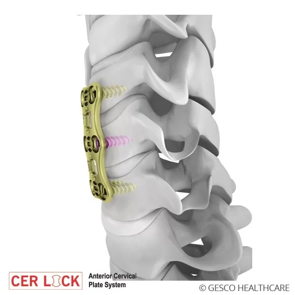 Anterior Cervical Plate System Spine implants-1