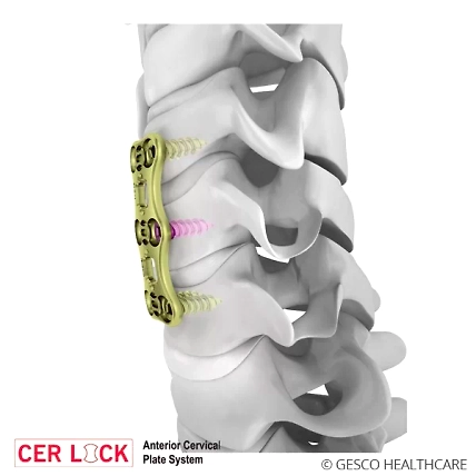 Anterior Cervical Plate System Spine implants-1